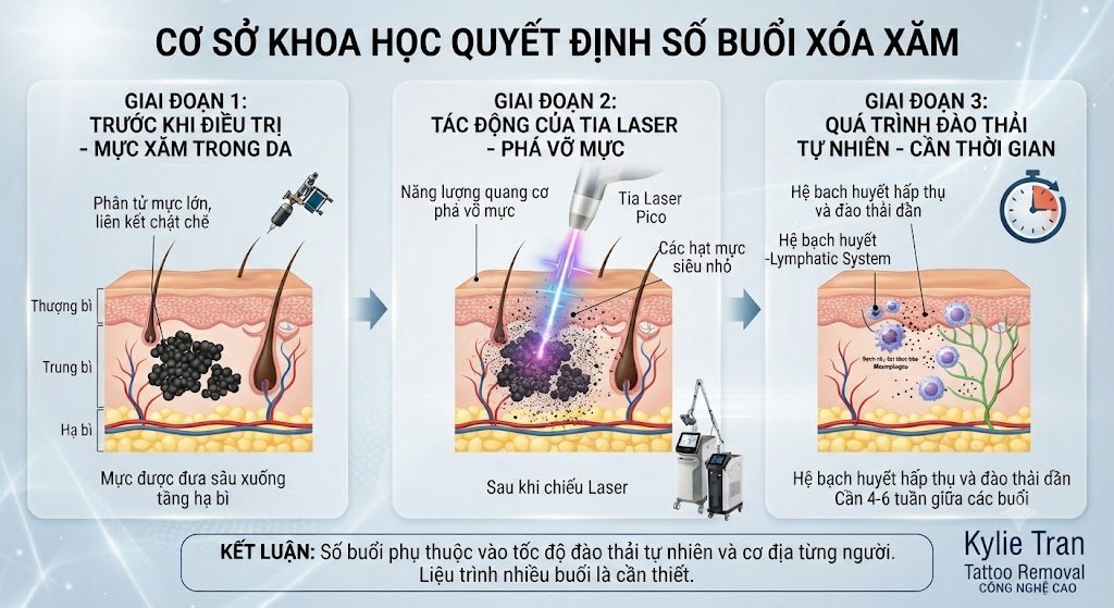 Xóa xăm bao nhiêu lần thì sạch hoàn toàn? Giải đáp từ chuyên gia