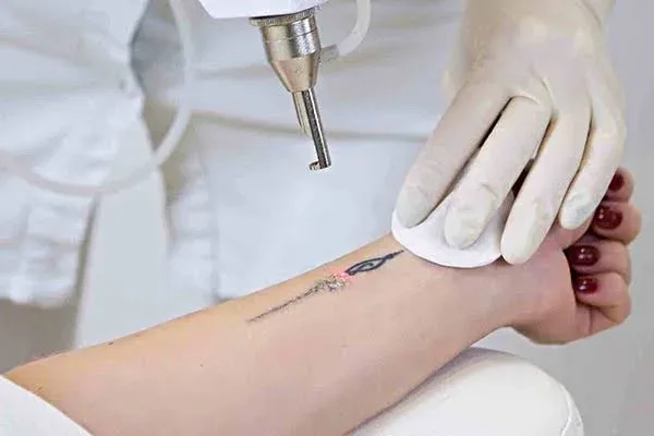 A laser handpiece being applied to a small tattoo on a client forearm