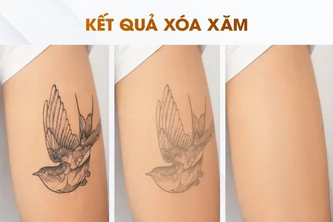 A swallow tattoo on an arm shown fading across three laser sessions