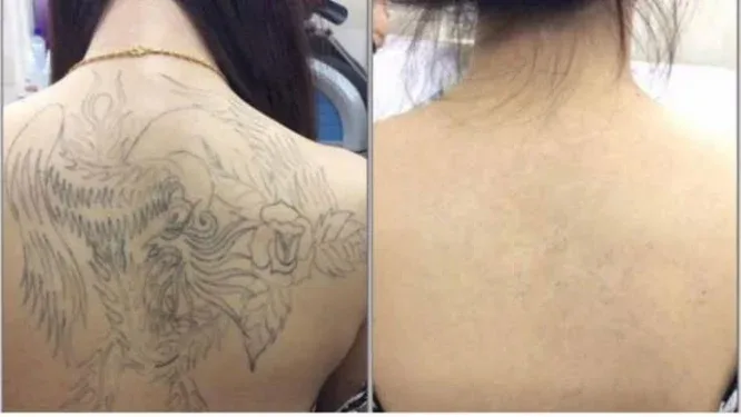 A large ornate back and shoulder tattoo shown before treatment and after laser removal