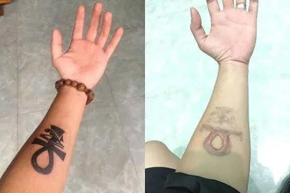 A dark symbol tattoo on a forearm shown before treatment and part way through fading