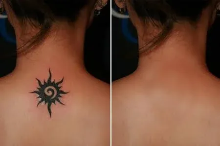 A small black tattoo on the nape of the neck shown before treatment and after laser removal