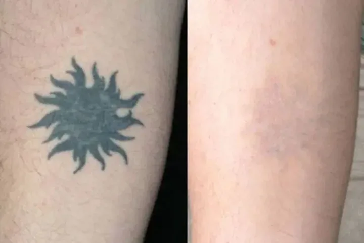 A solid black sun tattoo on a calf shown before treatment and after laser removal
