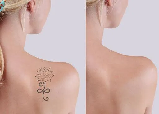 Lotus tattoo on a shoulder shown before treatment and after laser removal